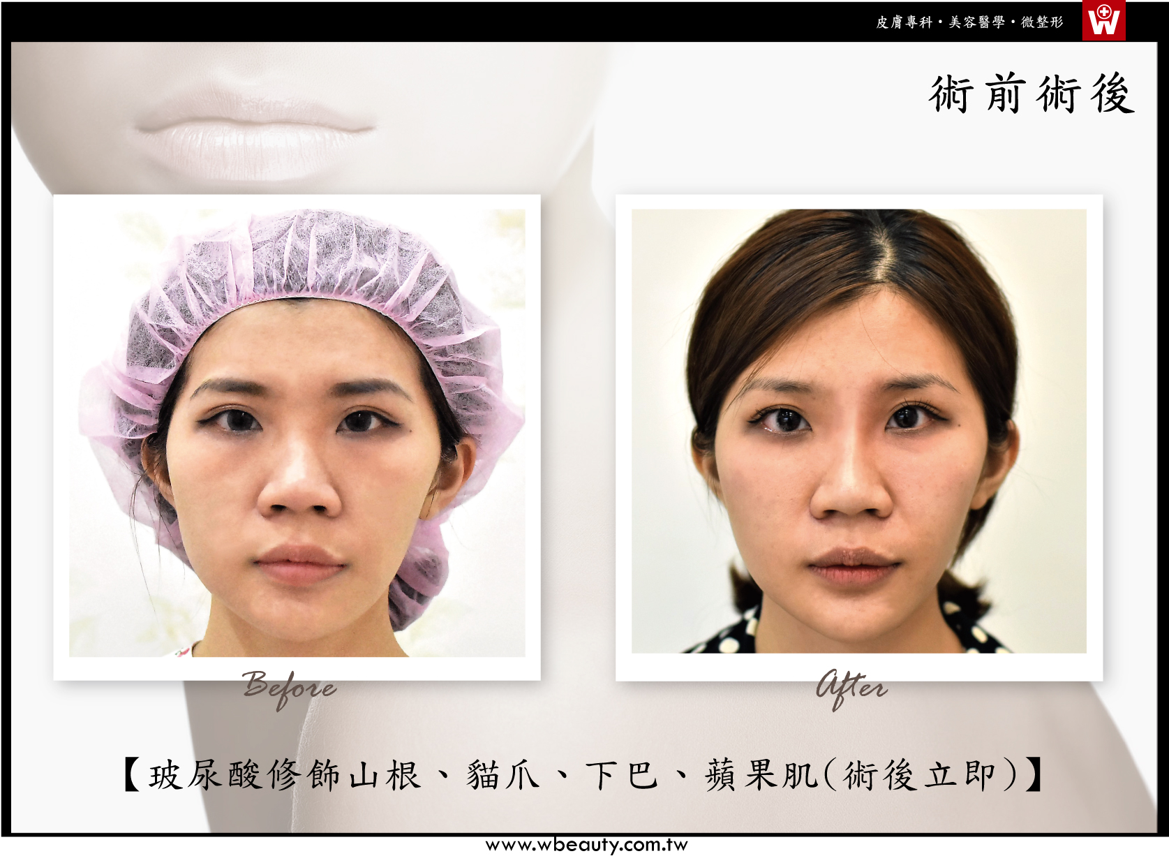 玻尿酸修飾山根貓爪下巴蘋果肌-術後立即